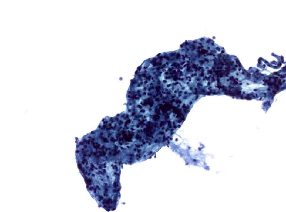 SAT : Anatomia Patologica PAP (ThinPrep) 20x : Tiroidite subacuta iniziale.