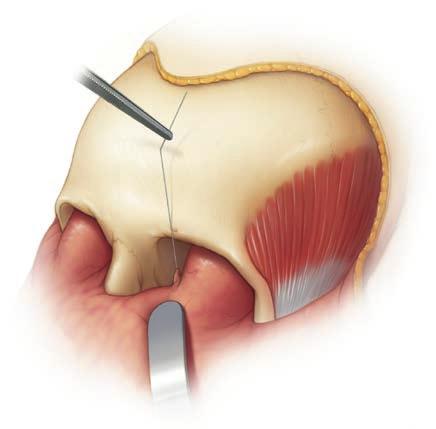 Metodo alternativo: utilizzando l'incisione caruncolare, l'uncino si aggancerà nella sostanza del tendine dopo che l'ago e il filo siano passati attraverso di