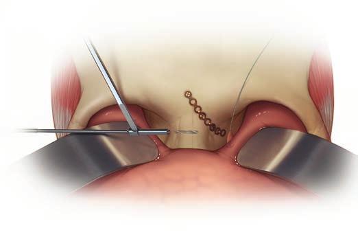 Tecnica chirurgica per la riparazione del tendine cantale mediale 7 Forare in direzione transnasale Usando una punta da 2.0 a 2.