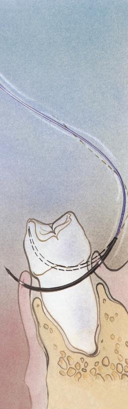 AGHI DA I primi aghi neri a curvatura composta per Chirurgia Odontoiatrica Gli aghi DA permettono al chirurgo un agevole utilizzo grazie alla loro esclusiva geometria.