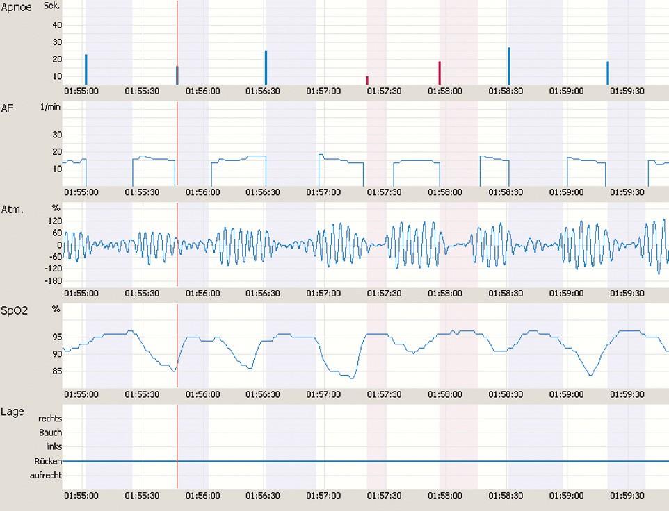 Per la validazione della rilevazione automatica degli episodi di apnea e ipopnea, il medico può commutare alla modalità revisione con un solo click del mouse.