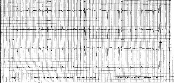 ECG di