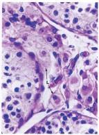 ad ammassi o cordoni cellulari (adenoipofisi, surrene, pancreas