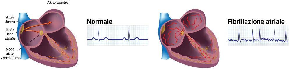 gestione e il trattamento della fibrillazione atriale, aritmia frequente specie nei soggetti anziani, forse un tempo sottovalutata e certamente sotto trattata, responsabile di fenomeni embolici