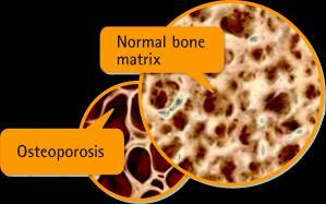 bone stability