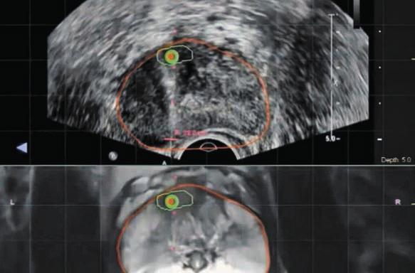 Iformazioe Saitaria ai Pazieti LA FUSION BIOPSY Iformazioi per il paziete cadidato a biopsia prostatica Itroduzioe Getile sigora, getile sigore, il seguete opuscolo ha lo scopo di forirle le