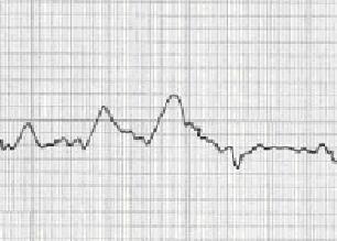 La tomografia computerizzata è adeguata a verificare le condizioni della protesi impiegata nella ricostruzione ossiculare. Fig. 5 - Timpanogramma in soggetto otospongiotico.