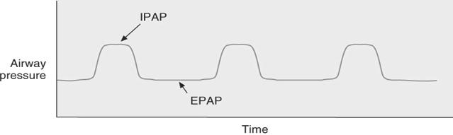 Bilevel Positive Airway Pressure BiPAP PSV vs BIPAP PSV IPAP 0 PEEP EPAP tempo PSV Pressione di picco = 8 cmh 2 0 PS = 4 cmh 2 0 PEEP = 4 cmh