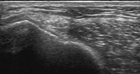 Controllare la cartilagine del versante posteriore del condilo femorale laterale utilizzando piani sagittali.