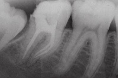 L Informatore Endodontico Vol. 10, Nr. 3 2007 lime in acciaio. Ignorare questo aspetto porta alla frattura di due strumenti Ni-Ti, uno in ciascun canale.