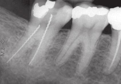 Utilizzo di un agente chelante e punte da ultrasuoni per rimuovere strumenti rotanti Ni-Ti fratturati i canali, specialmente per quanto riguardava lo strumento ubicato nella radice distale, che si