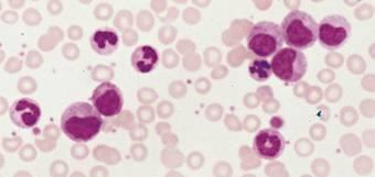 Striscio di sangue con leucemia mieloide cronica N EMOPOIESI EMOPOIESI Meta-Mc Mc Molti