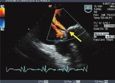 P Caso et al - Valutazione ecocardiografica delle protesi cardiache di una protesi e di un escursione incompleta, incostante o addirittura assente dell occlusore 9.