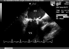 P Caso et al - Valutazione ecocardiografica delle protesi cardiache Figura 2.