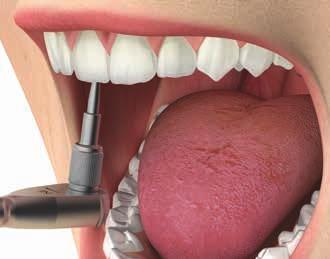 Avvitare la struttura in bocca al paziente rispettando un torque di 20-25 Ncm e chiudere il foro
