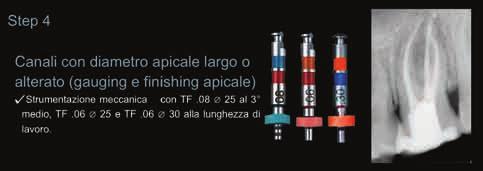 06 Ø 25, la tecnica TF consente di modificare e rifinire il solo diametro apicale utilizzando degli strumenti a conicità uguale o ridotta rispetto a quelli utilizzati alla lunghezza di lavoro nelle