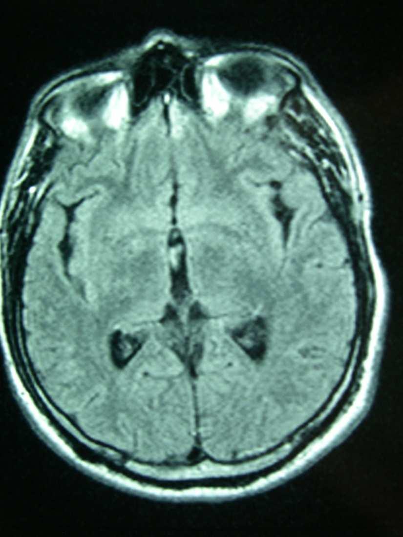 Paziente con pregresso trauma cranico che lamenta anosmia