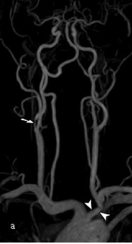 vasi epiaortici e circolo intracranico per il