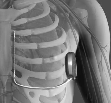 Il dispositivo e l elettrodo sottocutaneo vengono tipicamente impiantati a livello sottocutaneo nella regione toracica sinistra (Figura 1 Posizionamento del sistema