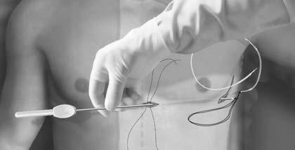 3. Utilizzando il materiale di sutura convenzionale, suturare il foro di ancoraggio dell elettrodo sottocutaneo allo strumento EIT creando un laccio lungo 15-16 cm (Figura