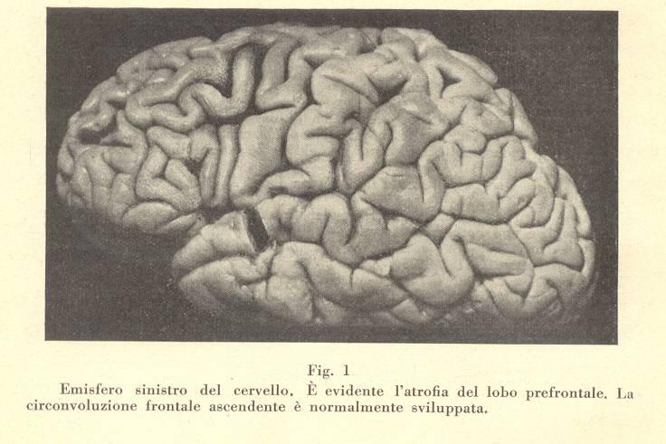 SQSTM1 Al-Chalabi et al.