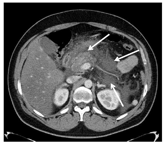 Fase venosa: le frecce indicano la testa del pancreas