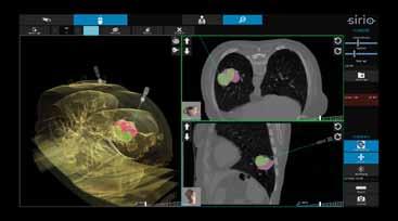 Tool di outlining Outlining tools Outlining and pre-interventional planning SIRIO allows the outline and isolation of a lesion on the basis of its morphometric and volumetric characterization so as