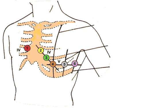 Posizionamento degli elettrodi L Elettrocardiografo è dotato di un cavo paziente.