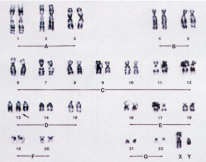 Le trisomie autosomiche nell uomo Trisomia 21 Trisomia 13 Trisomia 18