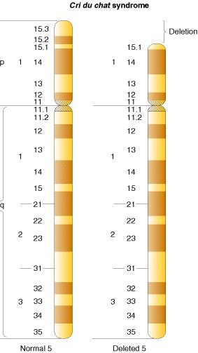 Esempio di delezione nell uomo La sindrome di cri-du-chat