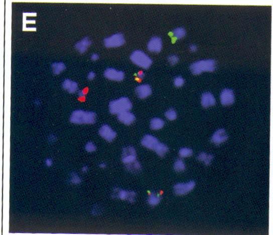tirosin-chinasi Leucemia Mieloide Cronica:cromosoma Philadelphia positiva [t(9;22)(q34;q11),