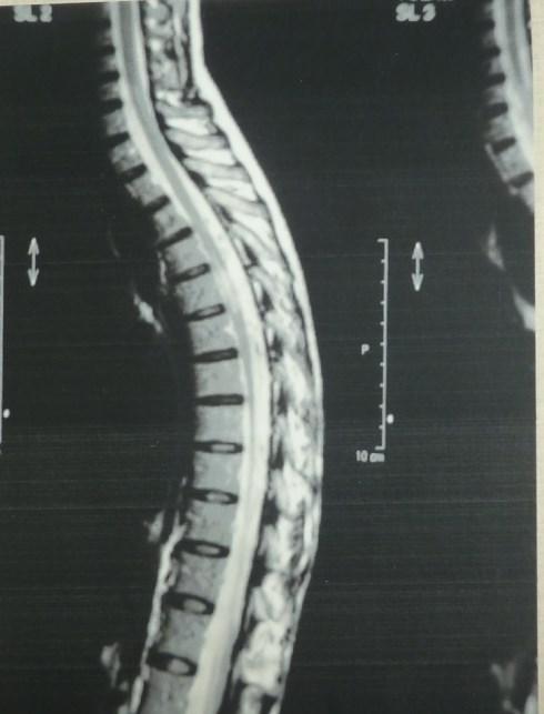 Nel 2009 ricomparsa dei sintomi neurologici L esame neurologico mostrava una paraparesi