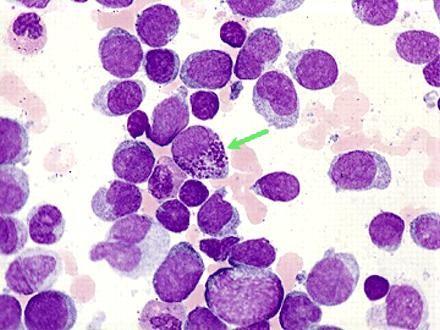 LEUCEMIA MIELOIDE