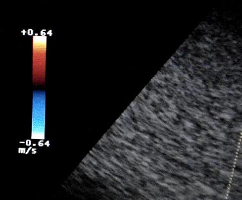 Nel Color-Doppler, la Pulse Repetition Frequency è addirittura inferiore a quella del Doppler-Pulsato, in quanto le pixels che vengono