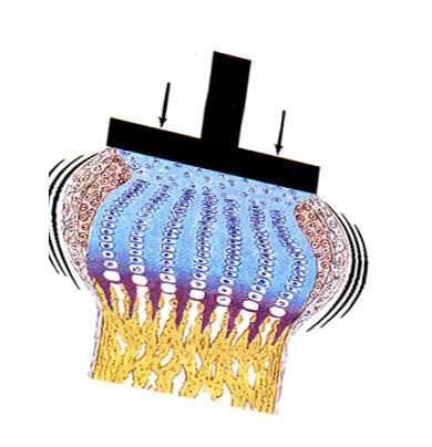 Fisiopatologia Danno della zona ipertrofica