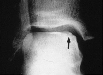 Lesioni associate: Fratture osteocondrali