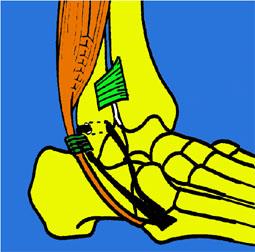 CASTAING che utilizzano il tendine del peroneo corto laterale