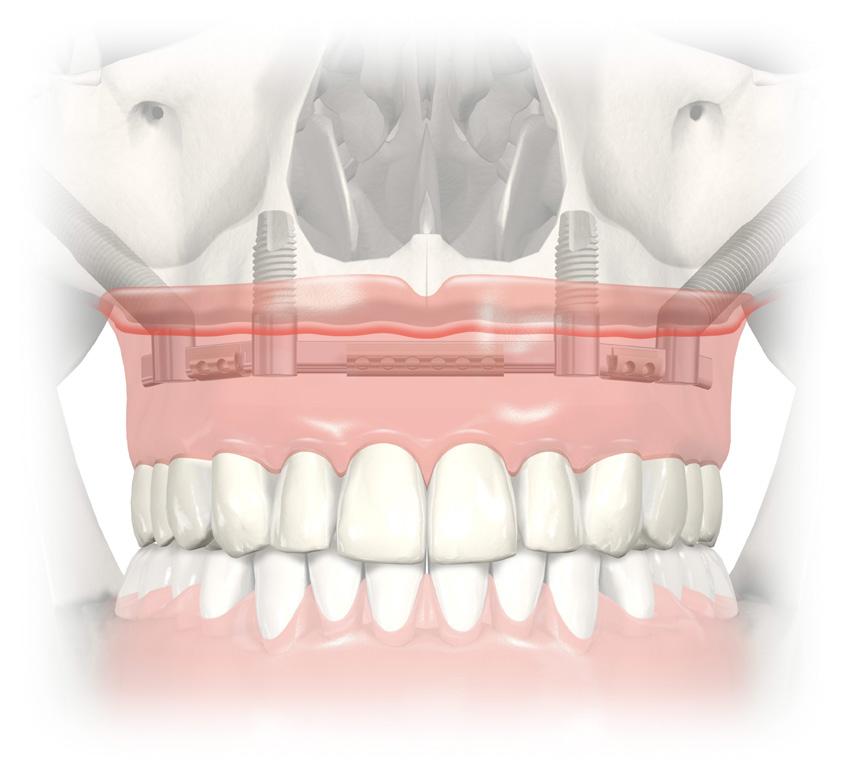 Componenti di laboratorio Abutment Replica Multi-unit Plus 38918 (1/pkg) 38919 (5/pkg) Vite da laboratorio Multi-unit 29287 (5/pkg) Protection Analog Multi-unit 5/pkg 29123 Guide Pin Multi-unit 10 mm