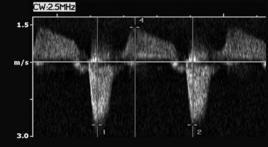 PW a sinistra, mentre CW a destra. 2.4 Trattamento del segnale di Doppler shift.