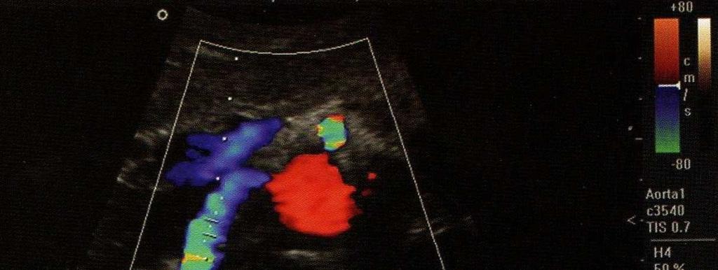 Doppler portale, fegato, vie biliari e sistema steno-portale sofferenza dell'emuntorio interessato (ad esempio in corso di insufficienza renale) ma anche della presenza di nefroangisclerosi