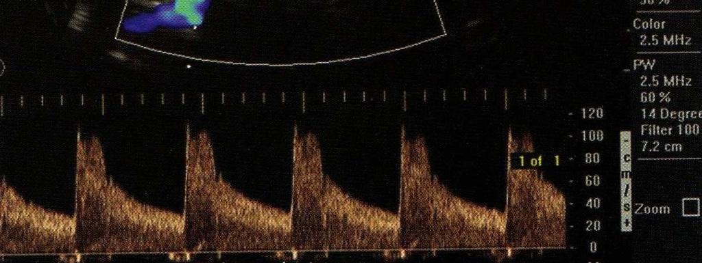 7 Immagine duplex dell arteria renale destra, color e pulsed Doppler. 5.