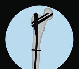 Chiodo per femore prossimale Caratteristiche specifiche: Vite del collo femorale (da Ø 11 mm) e perno per anca (da Ø 6,5 mm) per bloccaggio prossimale angolo laterale di 6 e diametro prossimale del