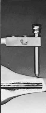 700 Boccola di protezione 11.0/8.0 Inserire la boccola di protezione da 11.0 mm/8.0 mm, con il trocar da 8.0 mm inserito, attraverso il foro corretto nell'archetto di inserzione.