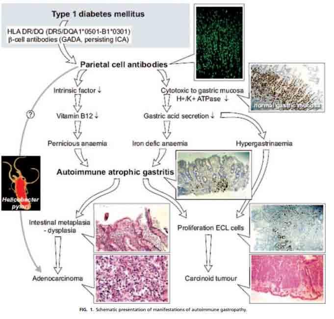 lievemente follicolare del corpo " Biopsie multiple mucosa gastrica (corpo e antro): gastrite atrofico-metaplasica del corpo con iperplasia delle cellule ECL.