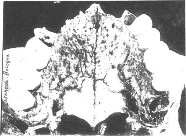 7) ed è appena accennata nel cranio n. ^ per la presenza di traccio della estremità posteriore tanto a destra che a sinistra.