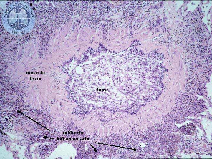 Principali caratteristiche anatomo-patologiche