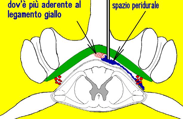 dorsalis conseguenze [da Orlandini G.