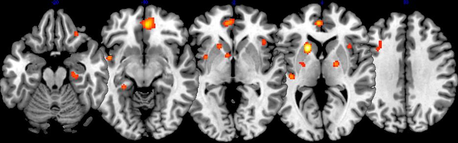 di neuroimaging con coordinate delle aree di