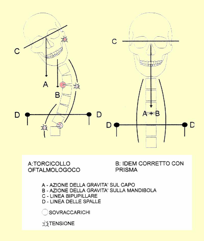 Problema cervicale Se il