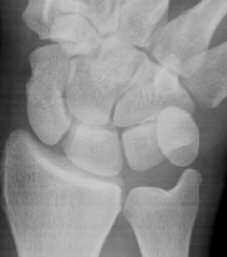 L OSTEOSINTESI DELLO SCAFOIDE CON VITE CANNULATA 315 A B Figura 1. A) Frattura dello scafoide; B, C) Osteosintesi percutanea per via volare.